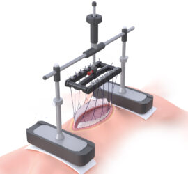 Abdominal wall solutions